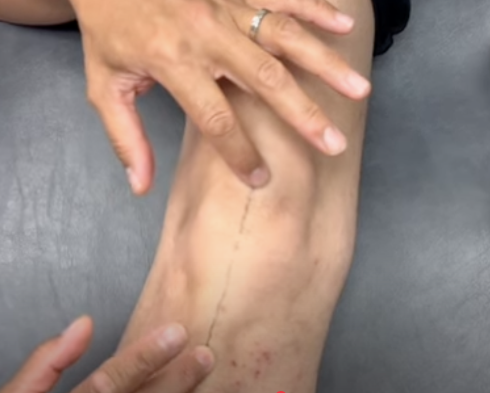 Fingers pointing at leg scar on knee